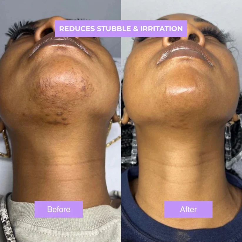 Viralaluna™ - Cyperus Rotundus Skin Serum - Image 4