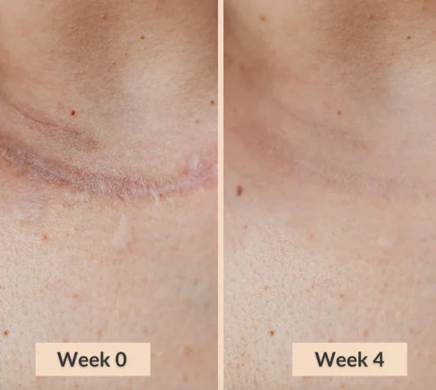 Silicone Scar Stick - Image 6