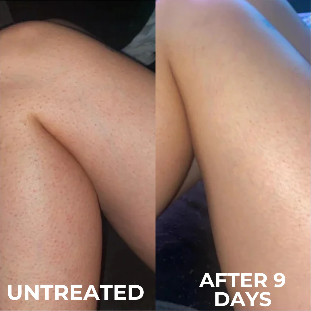 Advanced Triple-Acid Complex for Keratosis Pilaris - Image 6